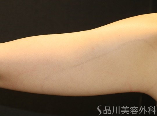 症例NO.72249のBEFORE写真