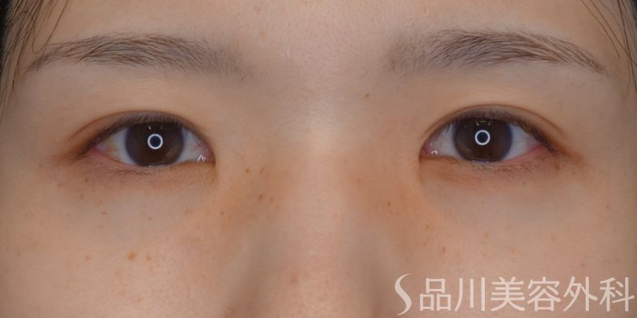 症例NO.74150のBEFORE写真