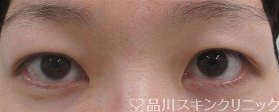 症例NO.27574のBEFORE写真
