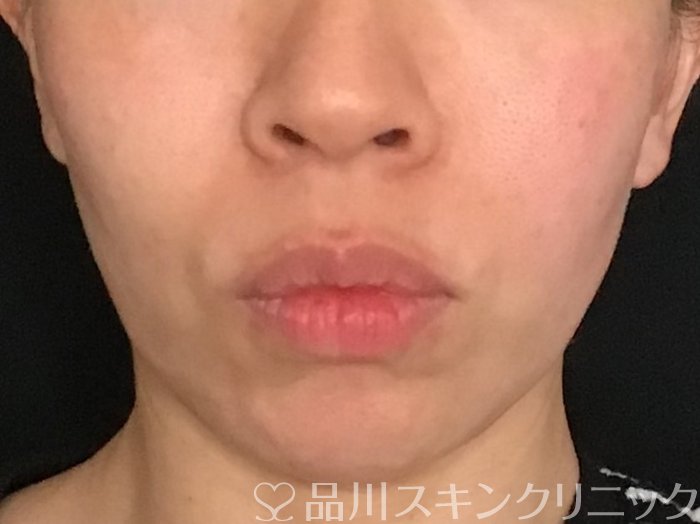 症例NO.65126のBEFORE写真