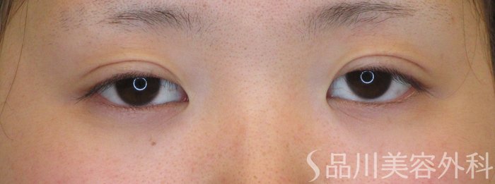 症例NO.71014のAFTER写真