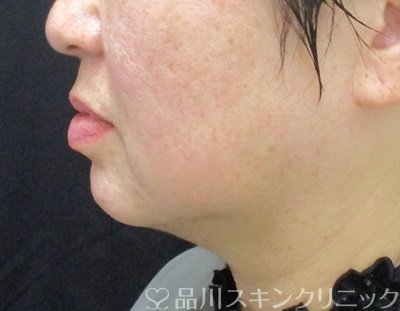 症例NO.69884のAFTER写真