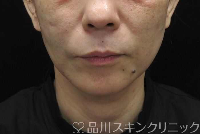 症例NO.74613のAFTER写真