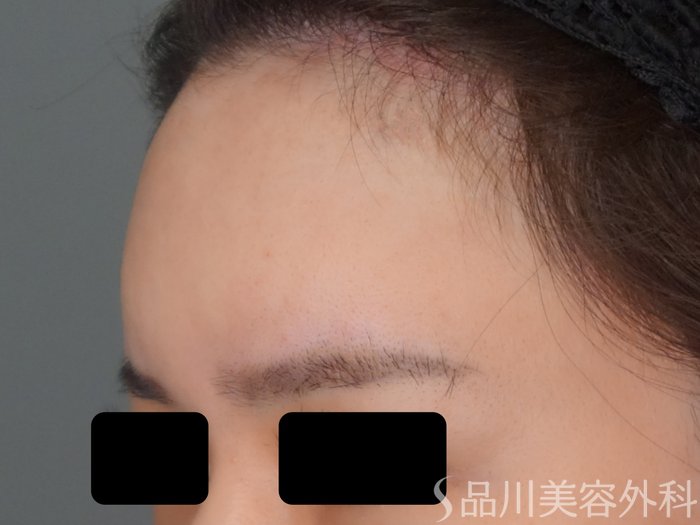 症例NO.69621のAFTER写真