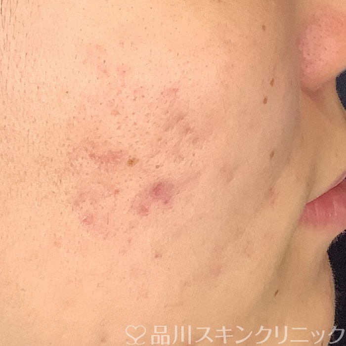 症例NO.69486のBEFORE写真