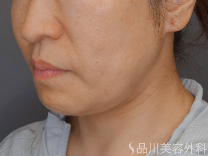 症例NO.71087のBEFORE写真