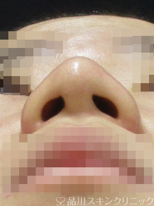 症例NO.70200のAFTER写真