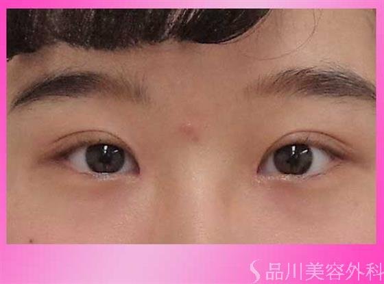 症例NO.41842のAFTER写真