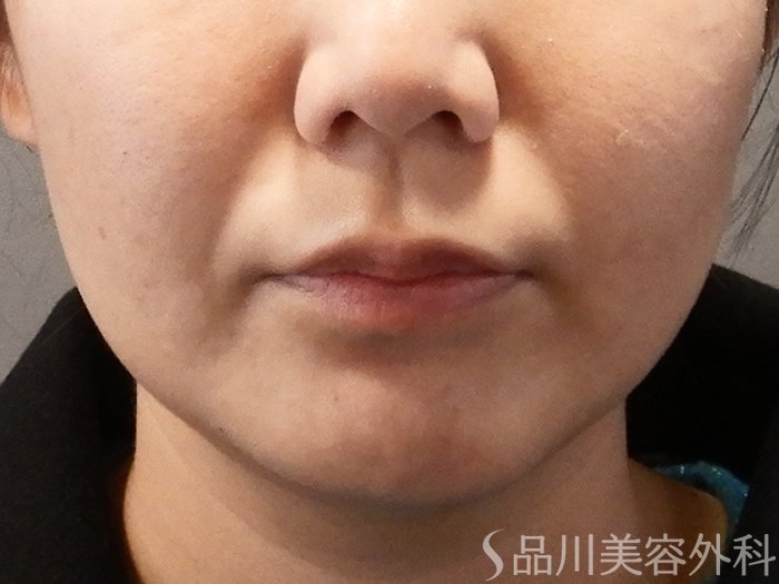 症例NO.67988のBEFORE写真