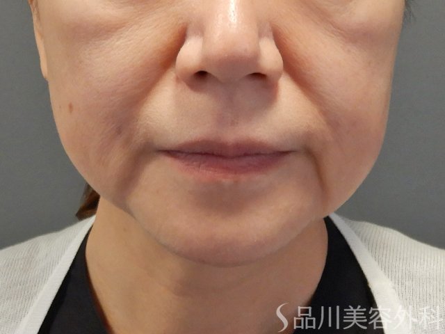 症例NO.72211のBEFORE写真