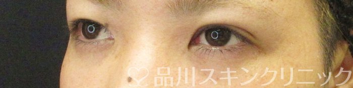 症例NO.67431のAFTER写真