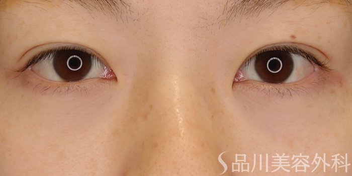 症例NO.71560のAFTER写真