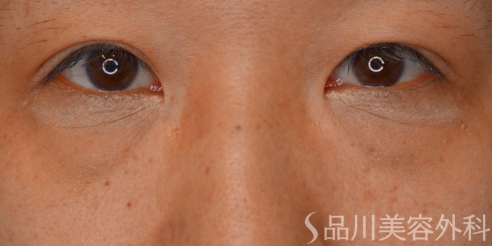 症例NO.62331のBEFORE写真
