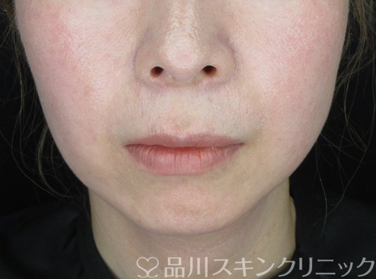 症例NO.70266のBEFORE写真