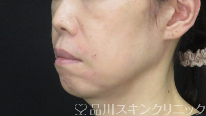 症例NO.72502のAFTER写真