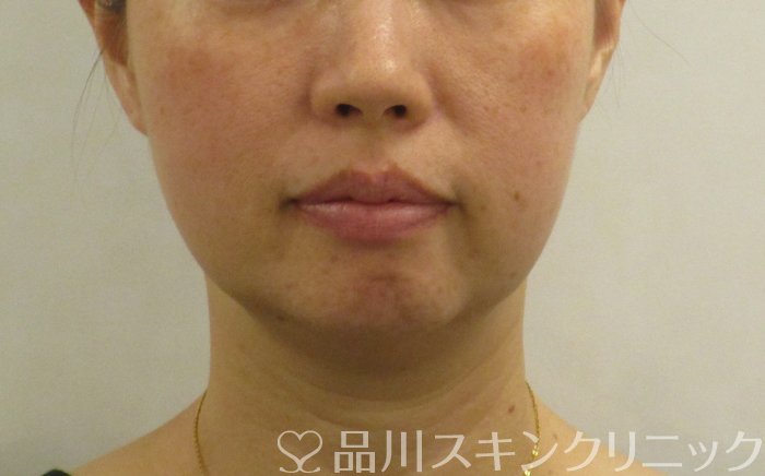 症例NO.68215のBEFORE写真