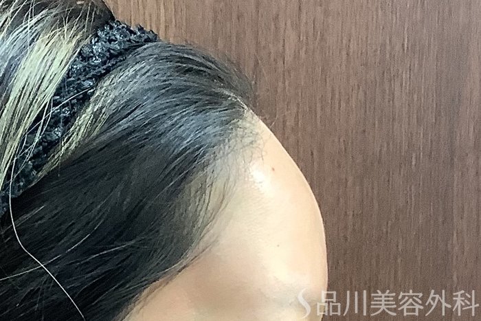 症例NO.67836のAFTER写真
