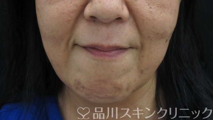 症例NO.74428のAFTER写真