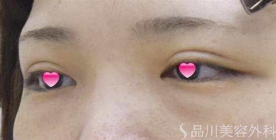 症例NO.53163のBEFORE写真