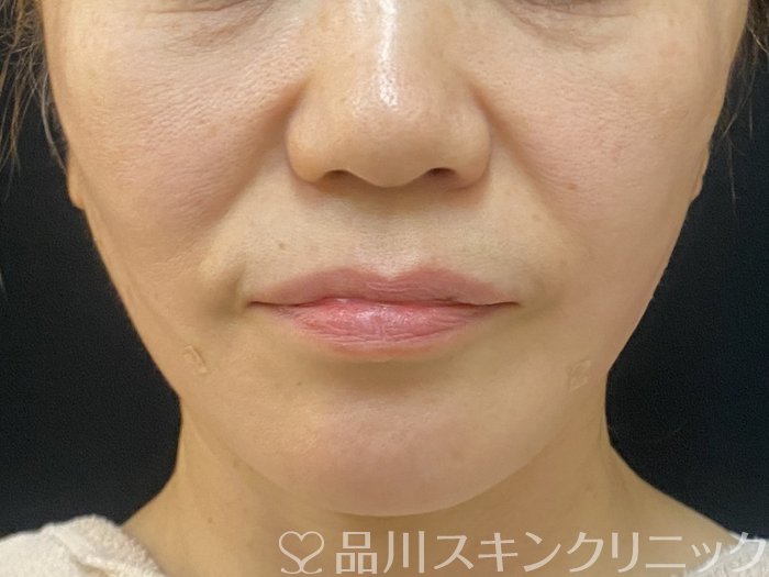 症例NO.74147のAFTER写真