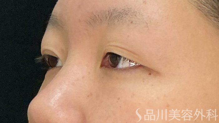 症例NO.71781のBEFORE写真