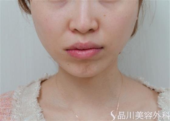 症例NO.47381のAFTER写真