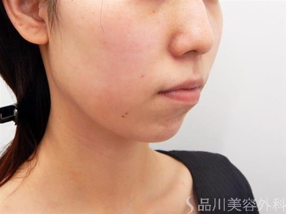 症例NO.52713のBEFORE写真