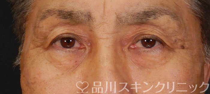 症例NO.66780のBEFORE写真