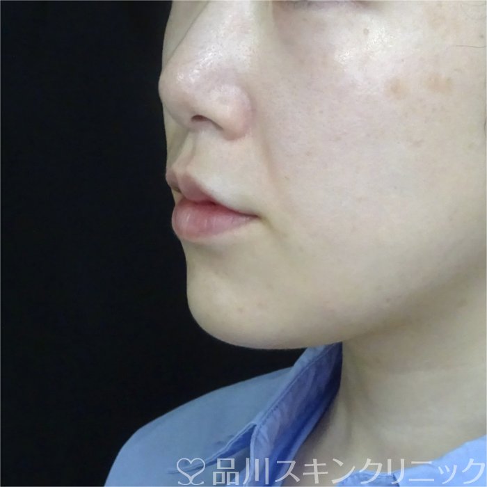 症例NO.70902のBEFORE写真