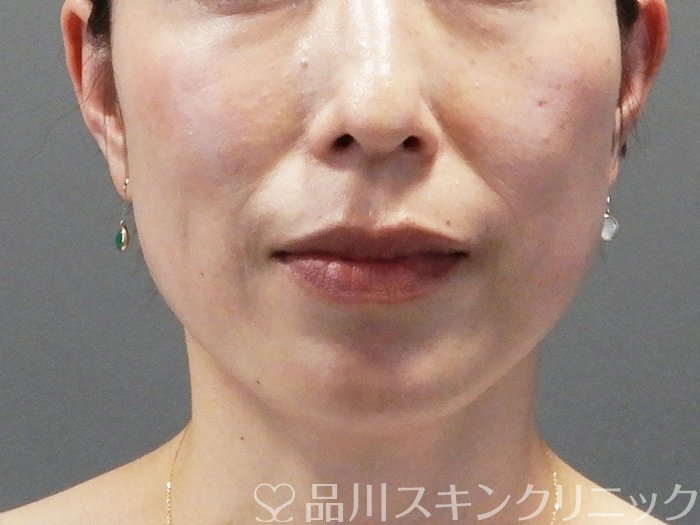症例NO.74357のBEFORE写真