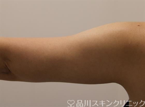 症例NO.45220のAFTER写真