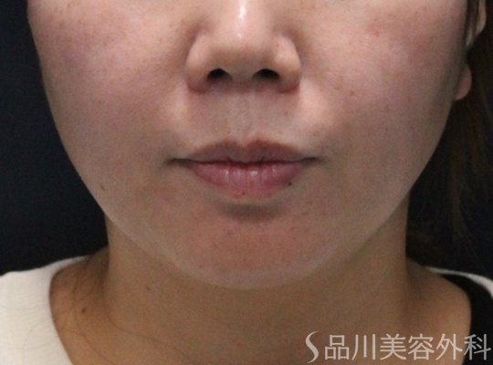 症例NO.75104のBEFORE写真