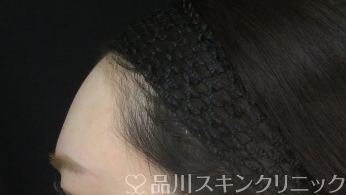 症例NO.71050のBEFORE写真