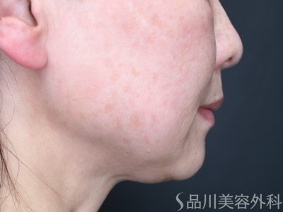症例NO.74149のBEFORE写真