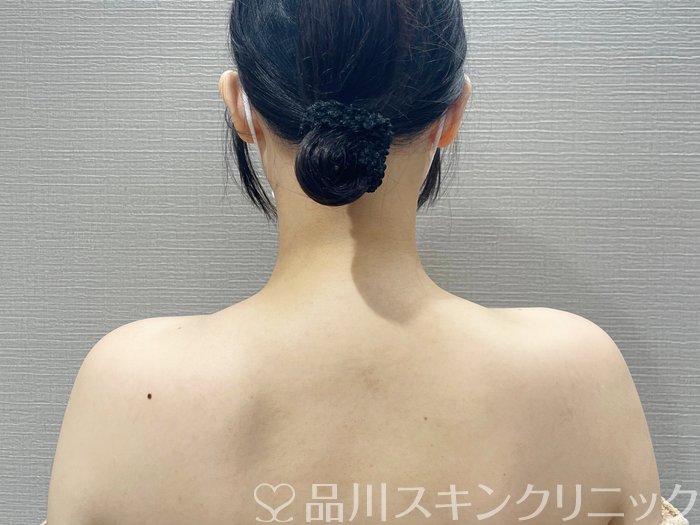 症例NO.73258のAFTER写真