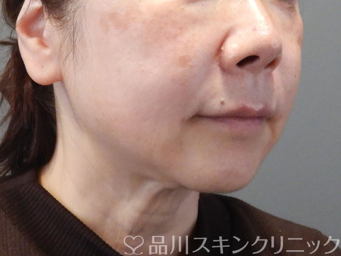 症例NO.73073のAFTER写真