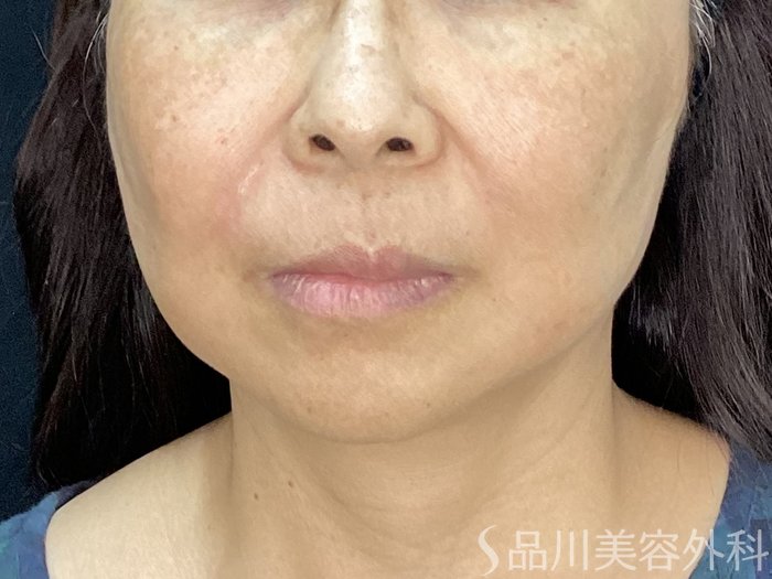 症例NO.71984のAFTER写真