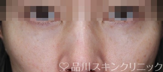 症例NO.70299のAFTER写真