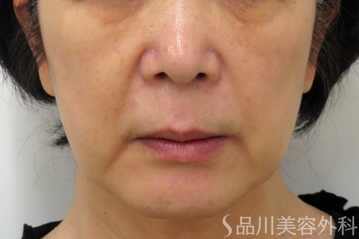 症例NO.74808のBEFORE写真