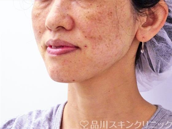 症例NO.48634のAFTER写真