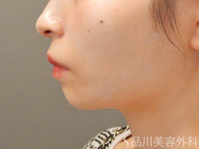 症例NO.71674のBEFORE写真