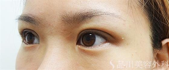 症例NO.25020のAFTER写真