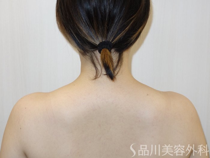 症例NO.65343のAFTER写真