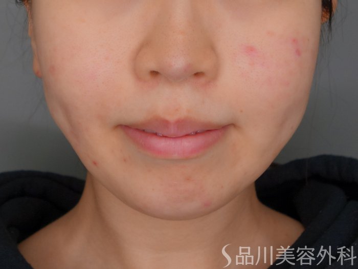 症例NO.73178のBEFORE写真