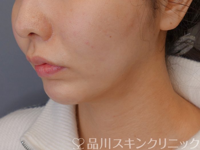 症例NO.72303のAFTER写真