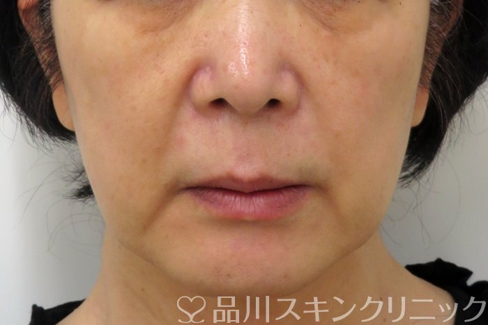 症例NO.74808のBEFORE写真