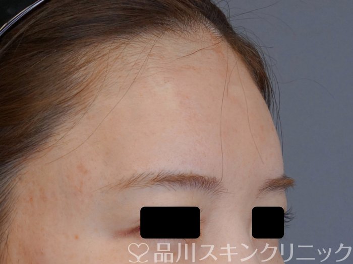 症例NO.74516のAFTER写真