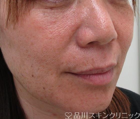 症例NO.30748のBEFORE写真