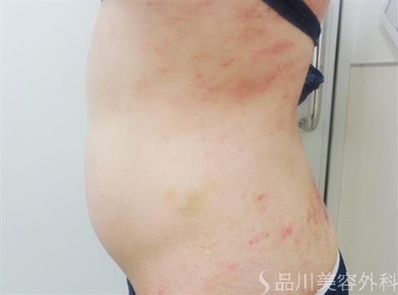 症例NO.23405のAFTER写真