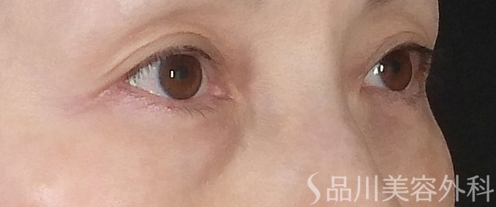 症例NO.68656のBEFORE写真